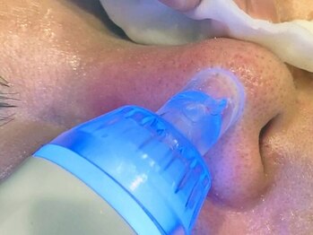 ミックスアップ 池袋店(Mix up!!)の写真/【人気のハイドラフェイシャル★今だけ¥4,980】毛穴の黒ずみ・ざらつきを徹底洗浄!ワントーン明るい美白肌