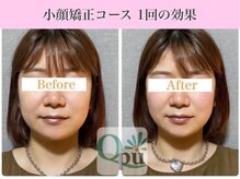 キュープ 表参道店(Qpu)/小顔矯正回コース1回の変化