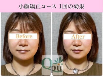 キュープ 表参道店(Qpu)/小顔矯正回コース1回の変化