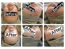 マッチ(much)/シミケア　肌管理