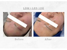 エヴァーグレース 三河安城店(EVER GRACE)/【肌管理】LDM＋LED