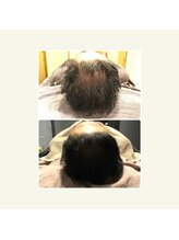 アディクト 富士店/育毛促進(40代男性)