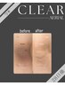 【黒ずみケア】CLEAR  ワキ ご相談０円