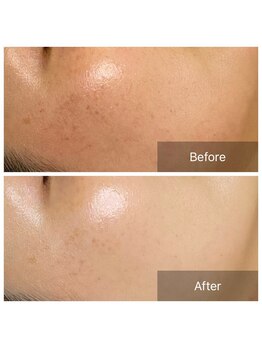 サロン グリッター 新宿(Salon GLITTER)/【肌質改善】ビフォーアフター