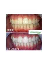 ホワイトニングサロン 名古屋駅店/【ホワイトニング施術例】