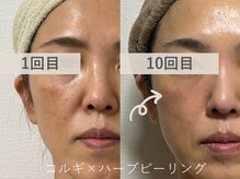 セレソル(CERESOL)/施術10回での効果