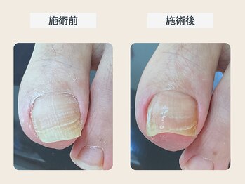 ルポ 伊勢/巻き爪ケア