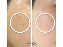 エステサロンパリス(Esthe Salon Paris)/シミ消えます！くすみ消えます！