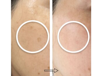エステサロンパリス(Esthe Salon Paris)/シミ消えます！くすみ消えます！