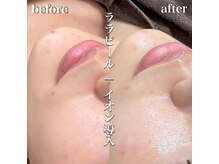 エムラボ 新宿店(M LABO)/ララピールイオン導入