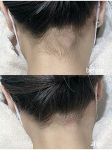エムズスタイル ネイルバー(M's Style NAIL BAR)/うなじ脱毛