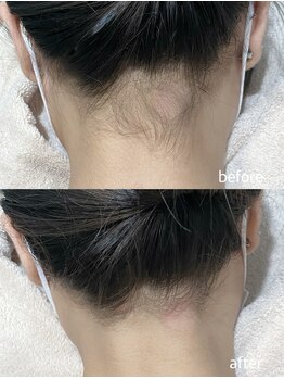 エムズスタイル ネイルバー(M's Style NAIL BAR)/うなじ脱毛