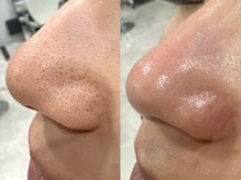 REBROW MEN'S リブロウ中目黒店 アイブロウ/メンズ眉毛サロン/眉毛パーマの雰囲気(美肌効果抜群、毛穴の黒ずみまで取れるピーリングFACE WAXも人気)