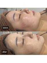 ロザブルー(ROSA BLU)/before/after 