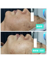 ボニータ(BONITA)/光エステ