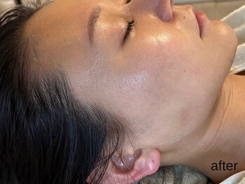 サロン ド エメ(salon de aimer)/【After】輪郭形成・肌質改善♪