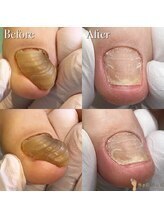 巻き爪補正店 札幌店/ 【分厚い爪/変形爪再生補正】