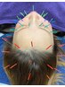 【美容鍼で美と健康を☆】　美容鍼セットコース　顔+頭部　50分