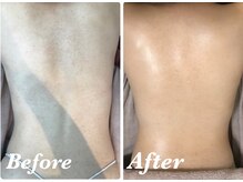 ルアナアイナ(Luana Aina)/背中ケア/ハーブピーリング