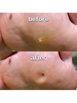 角質ケアコース