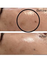 パールムーン(pearl moon)/毛穴の変化をご覧ください◎