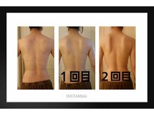 ウニ(uni)/【REVIハーブピーリング】背中