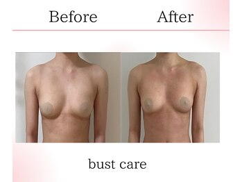 サロンツキ(salon tuki)/バストケア/症例