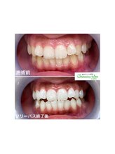 ホワイトニングサロン 名古屋駅店/【ホワイトニング施術例】