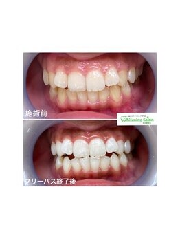 ホワイトニングサロン 名古屋駅店/【ホワイトニング施術例】
