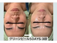 ルーチェ(LUCE)/グリーンピール5DAYS