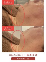 ミセル(MISEL2nd)/シュッとした輪郭に★小顔ケア