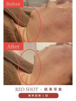 ミセル(MISEL2nd)/シュッとした輪郭に★小顔ケア