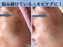 トータルビューティー ココ(Total Beauty CoCo)の雰囲気（何をしても改善しなかった毛穴・ニキビ本気で変えたい方へ）