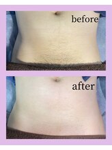 アンヴィオ ギンザ(Anvio Ginza)/お腹(Mパーツ)ワックス脱毛