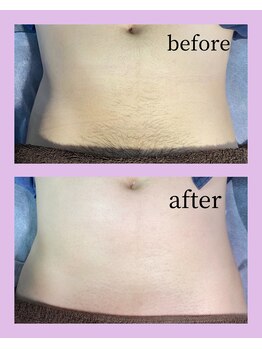 アンヴィオ ギンザ(Anvio Ginza)/お腹(Mパーツ)ワックス脱毛