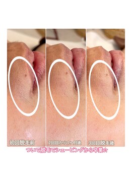 ジン フォー ユアビューティー(JIN for your beauty)/施術経過