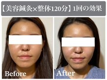 サンクエール 代官山鍼灸院(CINQ AILES)/美容鍼　食いしばり・むくみ改善