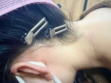 ハクミー(haku me)/☆光脱毛（うなじ）after☆