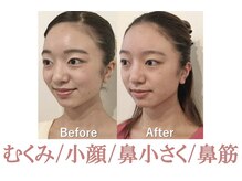 お顔の幅を細く小顔に☆ 鹿児島/小顔/小顔矯正/毛穴