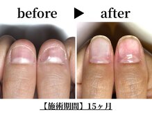 リング ザ ベル(ring the bell)/深爪・育爪専門コース