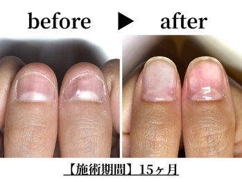 リング ザ ベル(ring the bell)/深爪・育爪専門コース