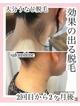 サロンシャイン(Salon Shine)/うなじ脱毛2回目から2か月後