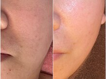 肌質改善もお任せください◎プラズマ・エレクトロポレーション