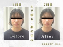 シルク(SILK)/エラ張り・左右差・たるみ改善