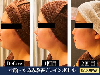 エヴァーグレース 川崎店/毛穴が気になりだしたら韓国美容