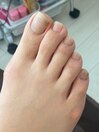 爪のお悩みbefore