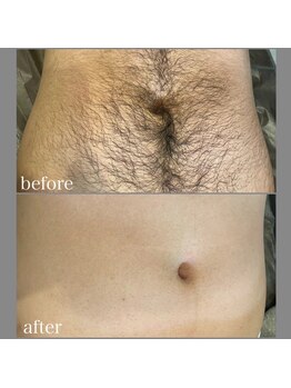 ブルーグロウ(Blue Glow)/お腹脱毛ビフォーアフター