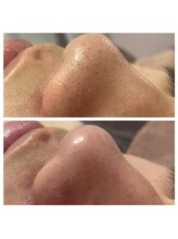 ルアナ(Luana)/毛穴洗浄でメンズもツルツル肌に