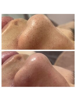 ルアナ(Luana)/毛穴洗浄でメンズもツルツル肌に