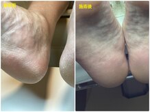 フットケアリストシュウ(footcarelist shu)/施術【角質ケア】素足美人♪